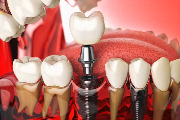 Çayyolu Diş İmplantı