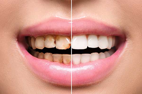 Diş Sararması Tedavisi